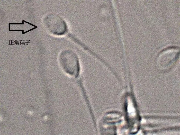 IMSI技术放大7200倍正常精子